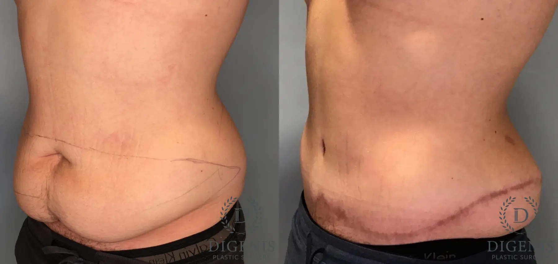 Tummy Tuck: Patient 36 - Before and After 4