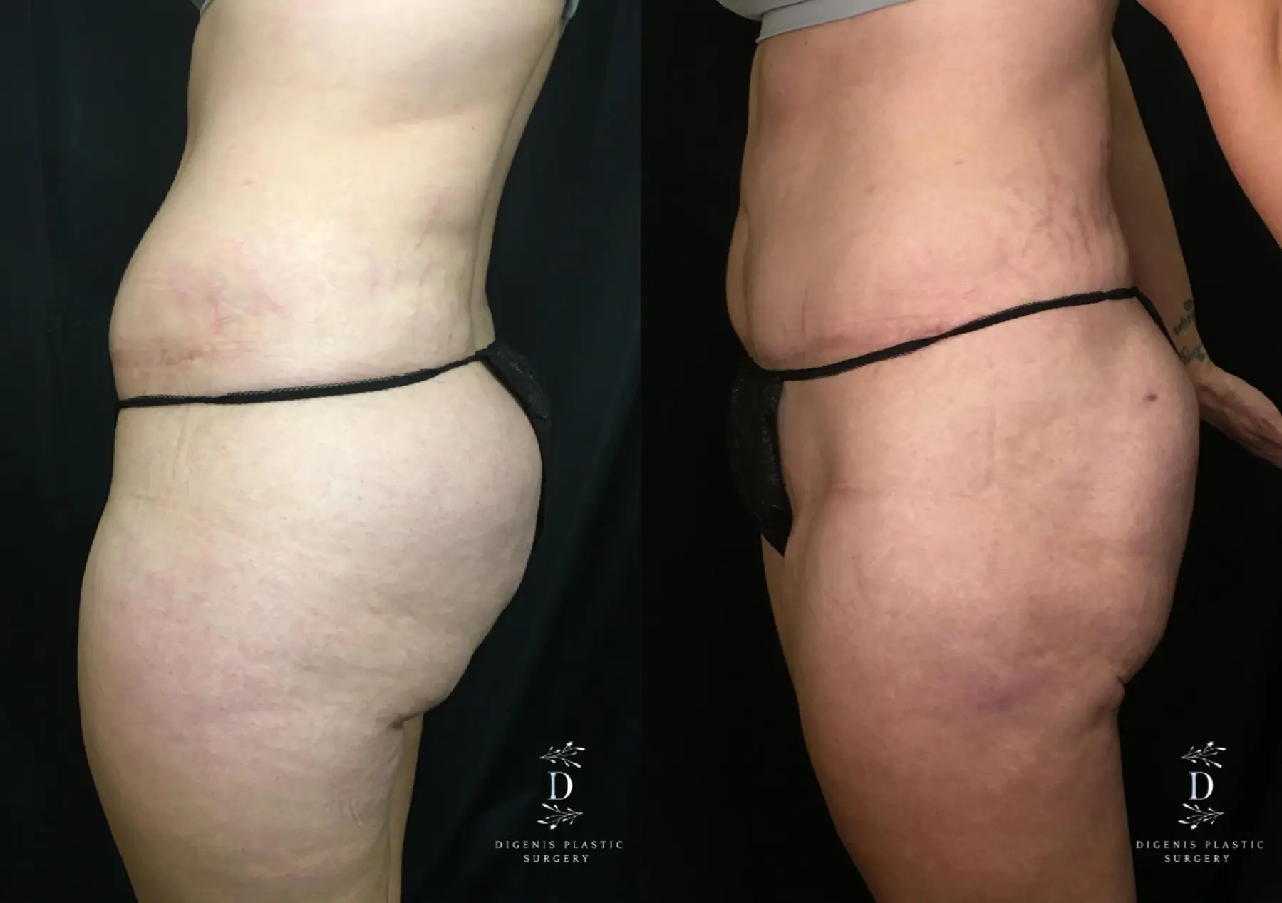 Tummy Tuck: Patient 21 - Before and After 5