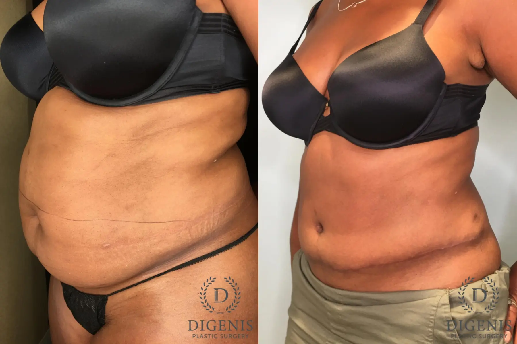 Tummy Tuck: Patient 13 - Before and After 2