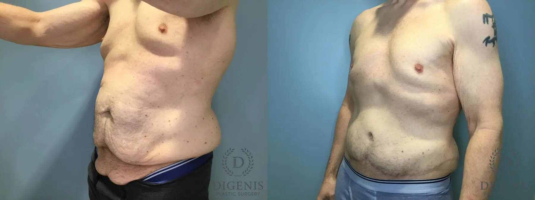 Tummy Tuck: Patient 5 - Before and After 4