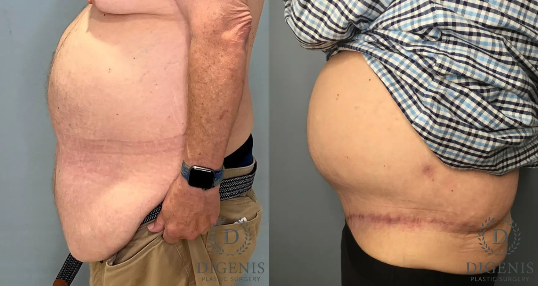 Tummy Tuck: Patient 4 - Before and After 3