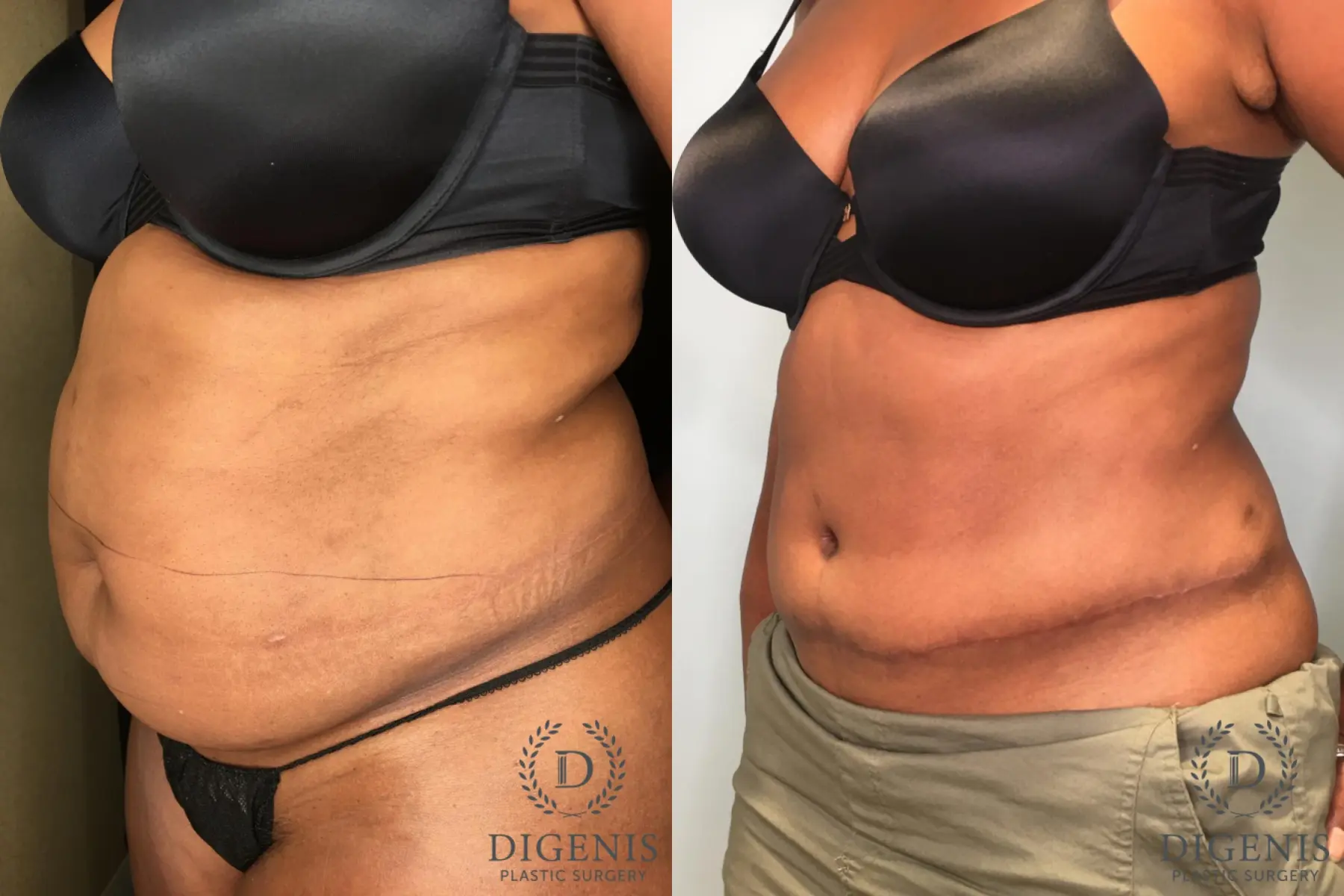 Tummy Tuck: Patient 24 - Before and After 4