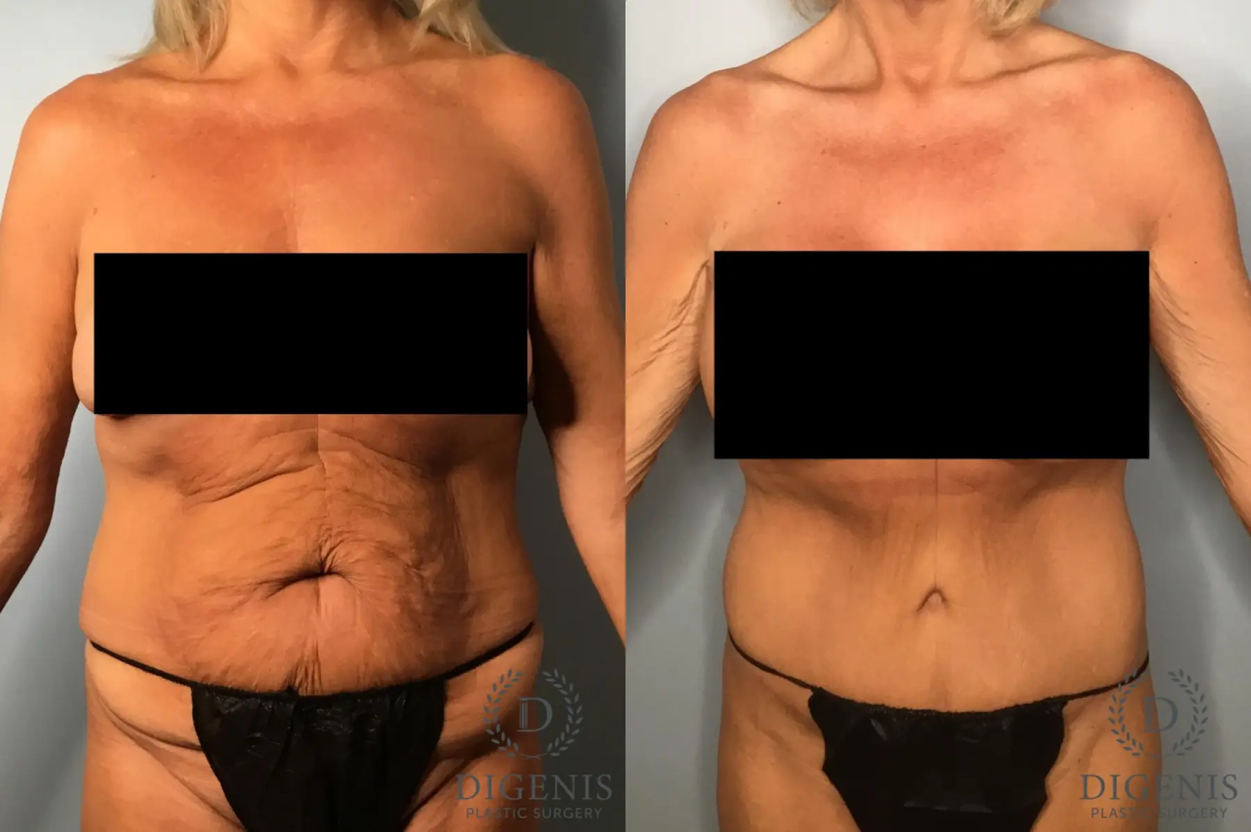 Tummy Tuck: Patient 32 - Before and After 1