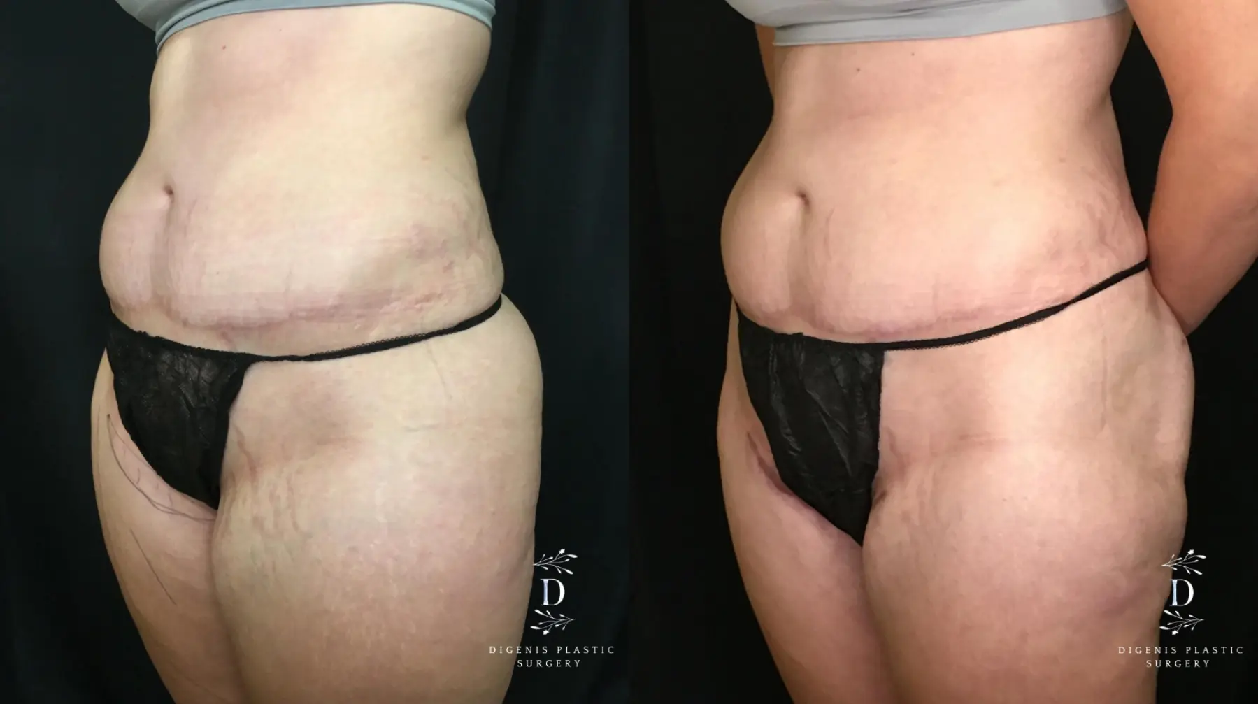 Tummy Tuck: Patient 21 - Before and After 4