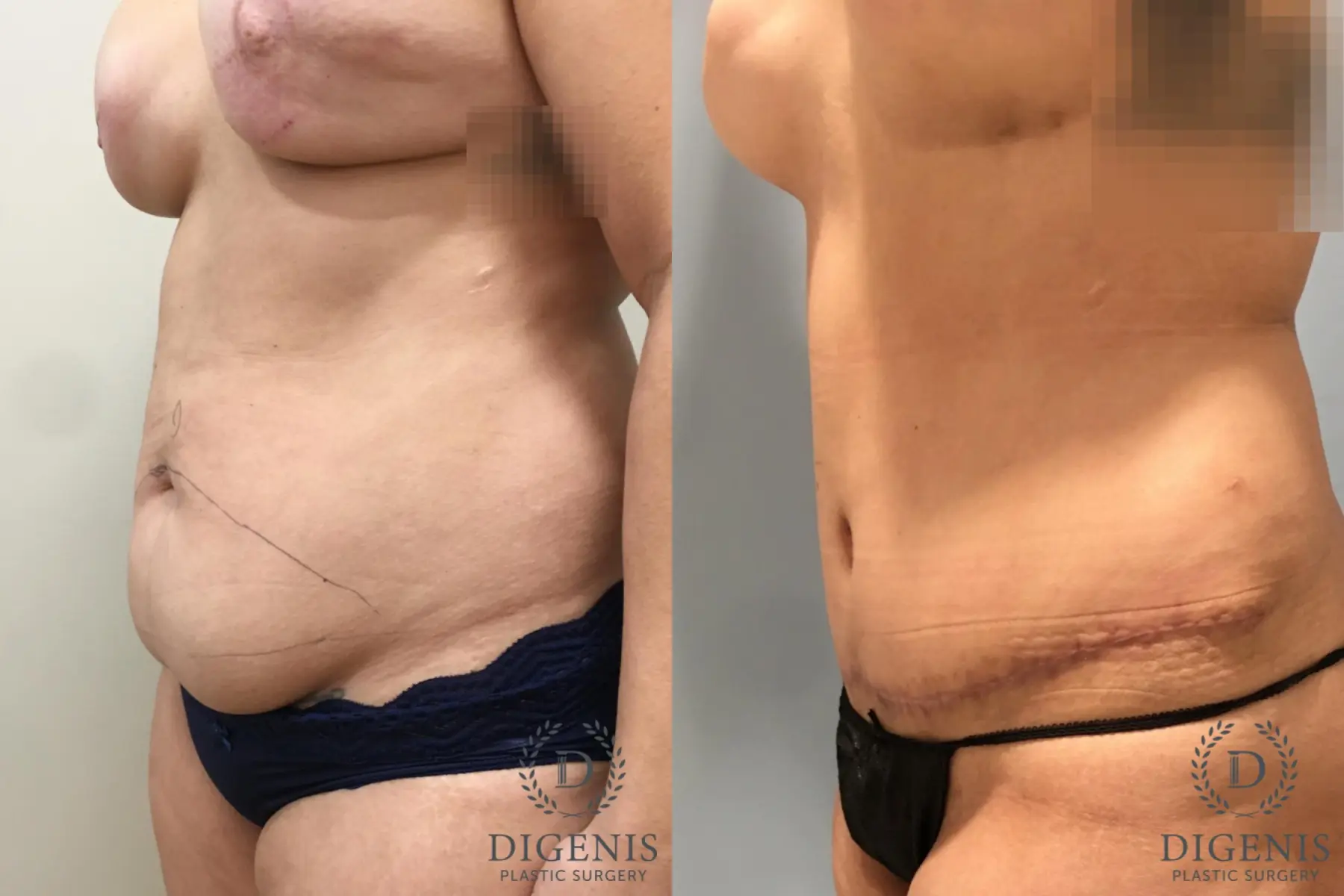 Tummy Tuck: Patient 26 - Before and After 4