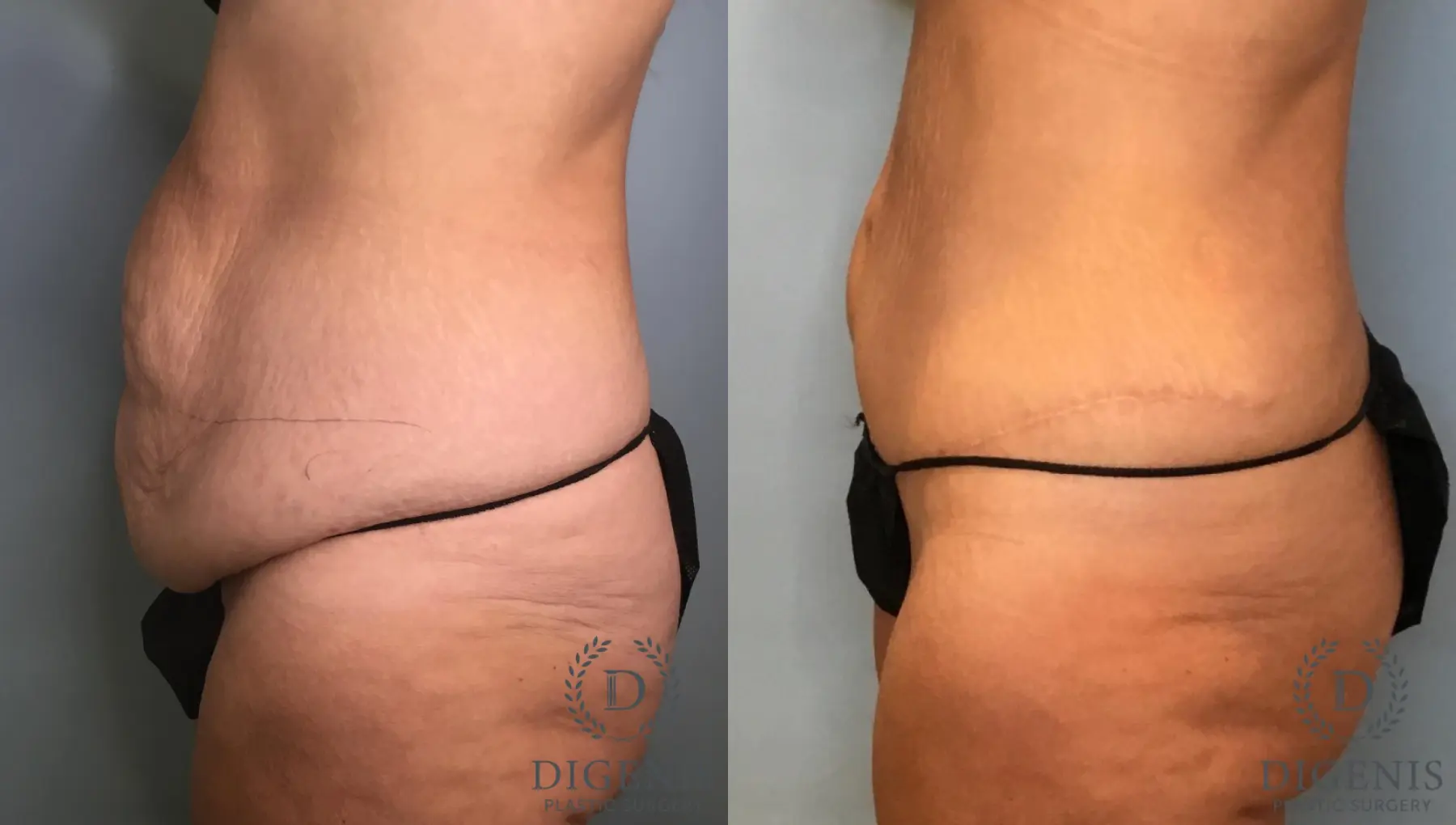 Tummy Tuck: Patient 23 - Before and After 3