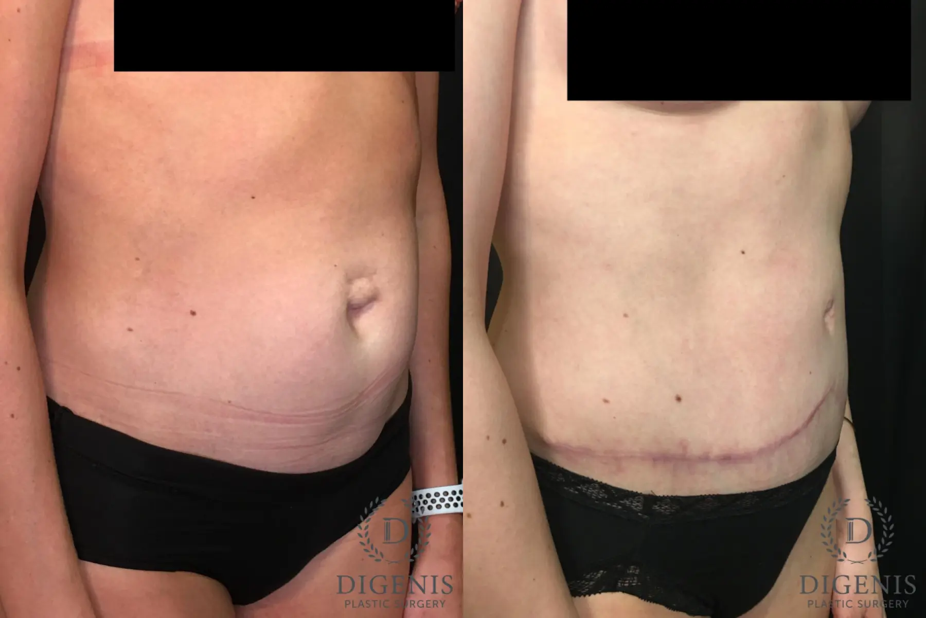 Tummy Tuck: Patient 3 - Before and After 2
