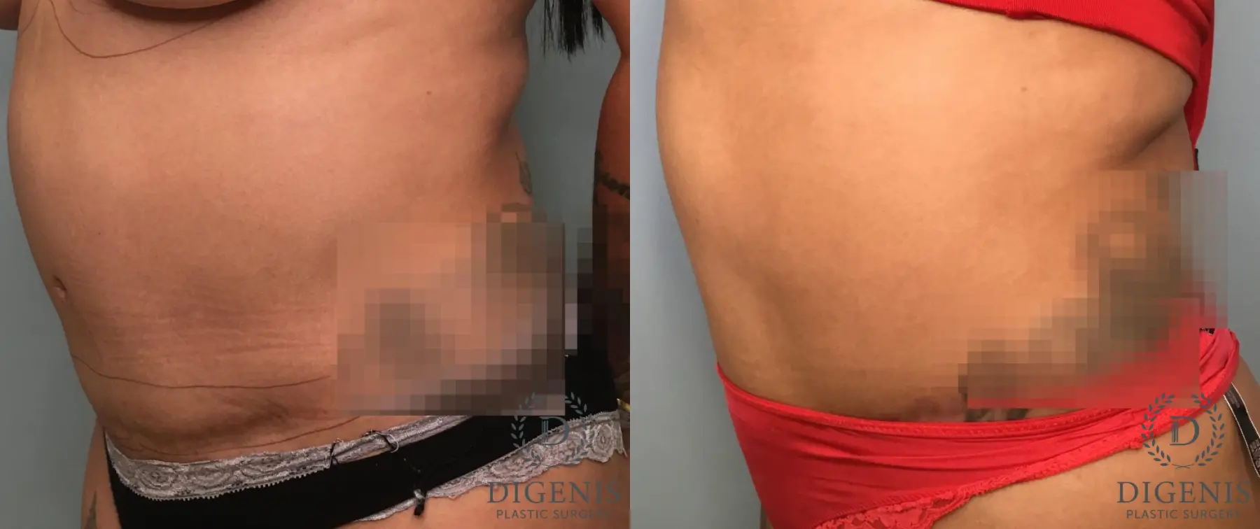 Tummy Tuck: Patient 35 - Before and After 4