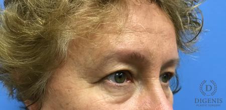 Eyelid Surgery: Patient 4 - Before 2
