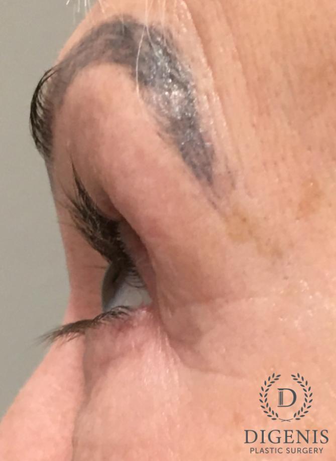 Blepharoplasty: Patient 15 - Before and After 9