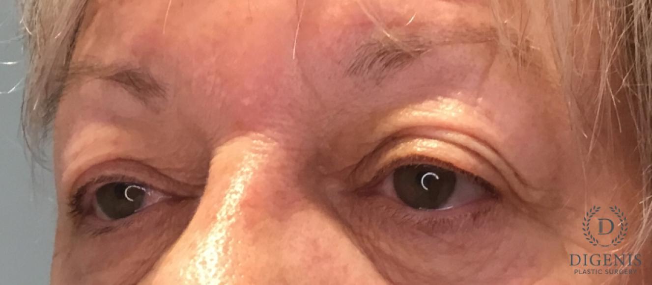 Eyelid Surgery: Patient 77 - Before 4
