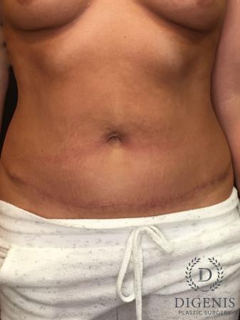 Abdominoplasty: Patient 1 - After 1