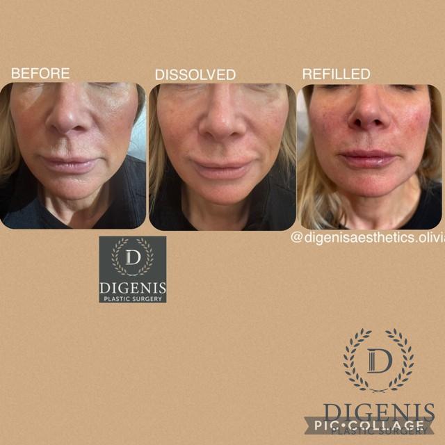 Injectables: Patient 10 - Before and After  