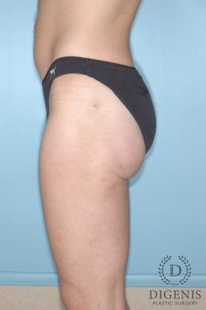 Liposuction: Patient 6 - After 4