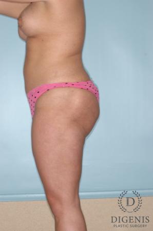 Liposuction: Patient 5 - After 4