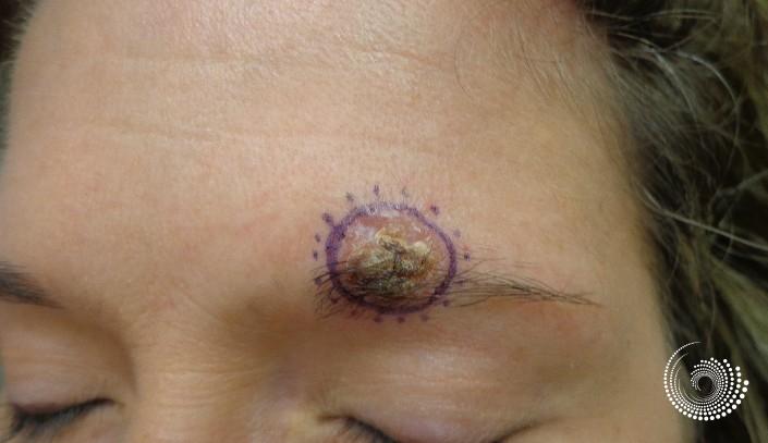 Basal Cell skin cancer, forehead near eyebrow - Mohs surgery - Before 2