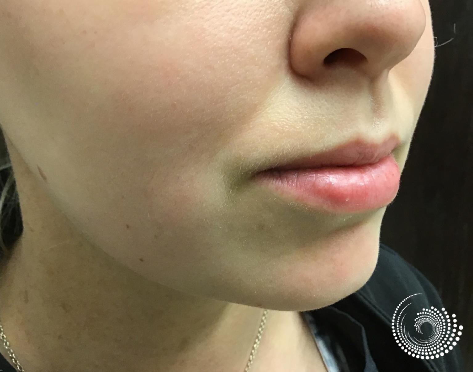 Filler - Lips: Patient 5 - Before 2