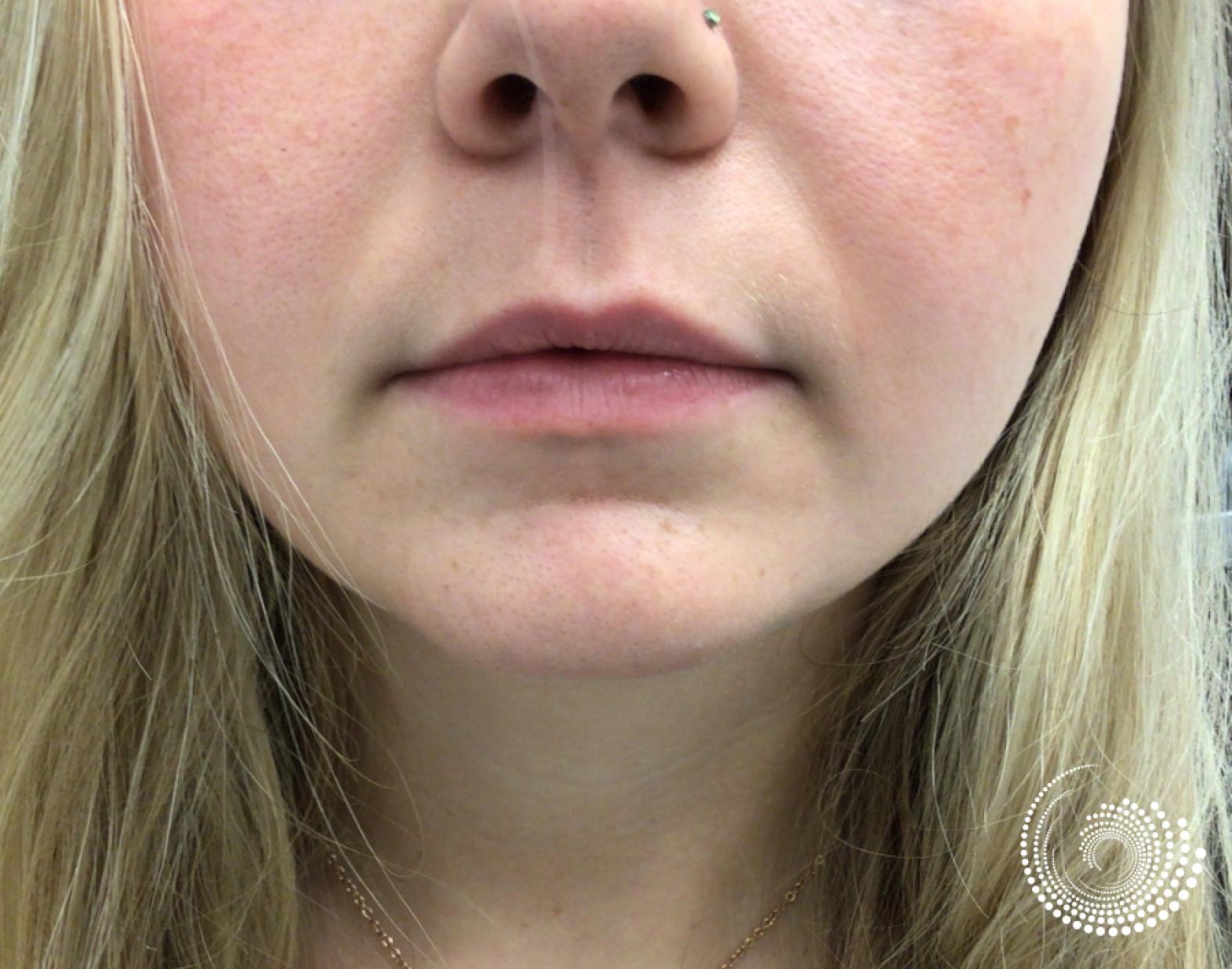 Filler - Lips: Patient 6 - Before 2