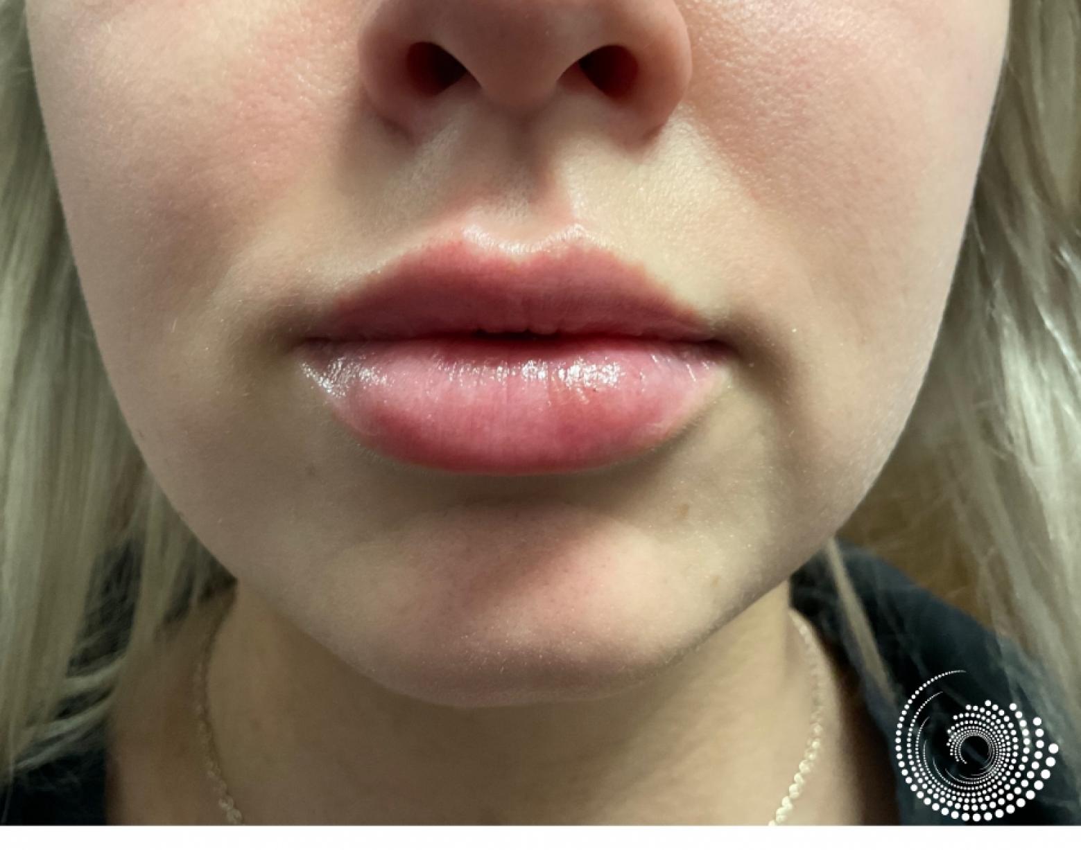 Filler - Lips: Patient 5 - After 1