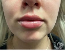 Filler - Lips: Patient 5 - After 