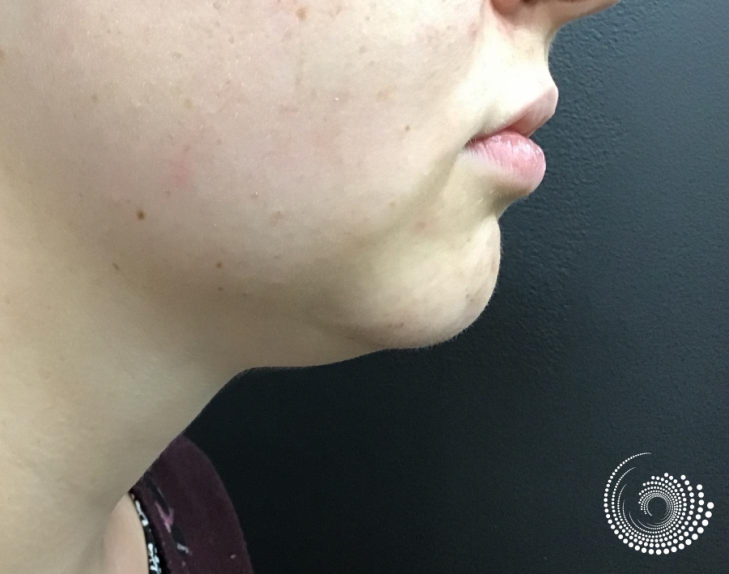 Kybella: Patient 1 - Before and After 2