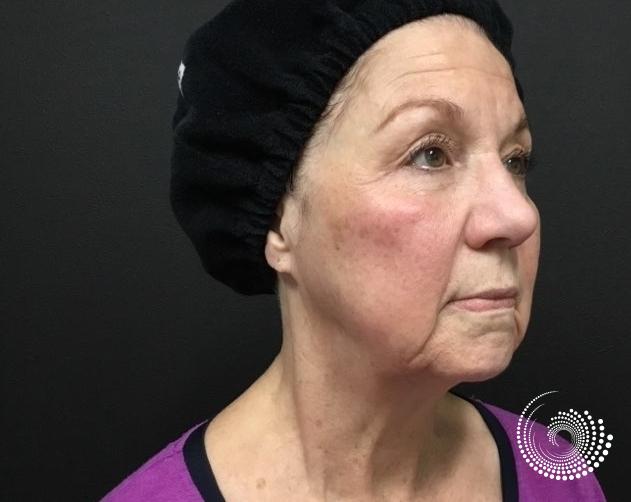 Ultherapy: Patient 1 - Before 