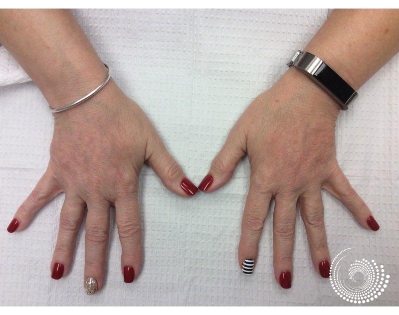 Filler - Hands: Patient 1 - After 1