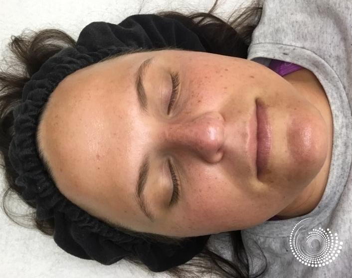 SkinPen Microneedling: Patient 1 - After  
