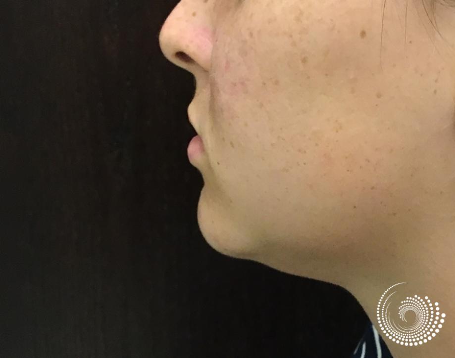 Kybella: Patient 1 - After  