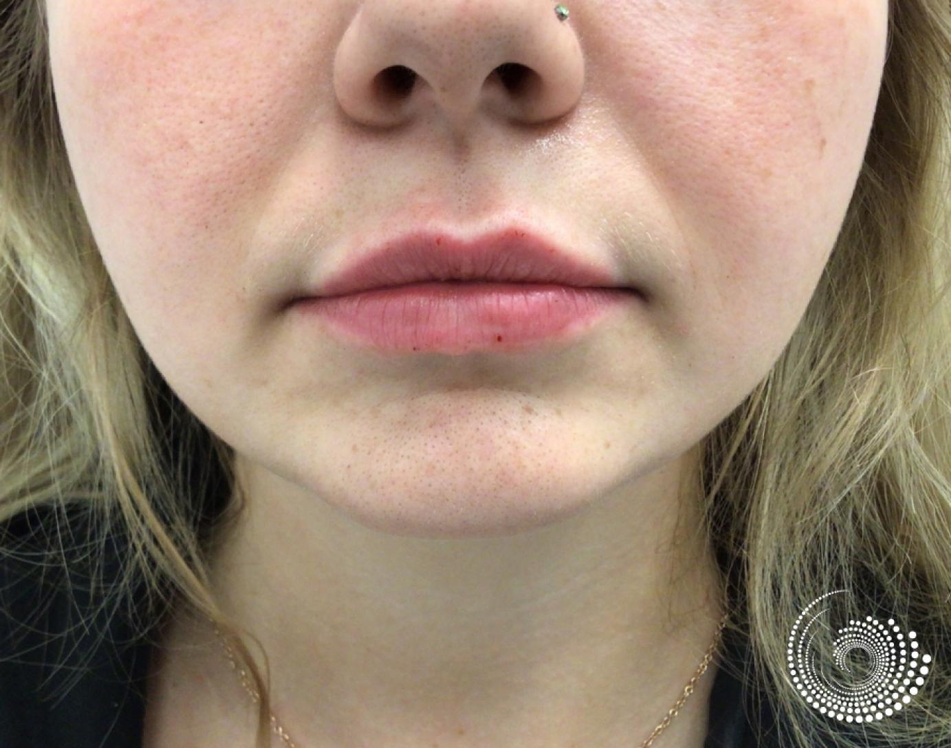 Filler - Lips: Patient 6 - After 2