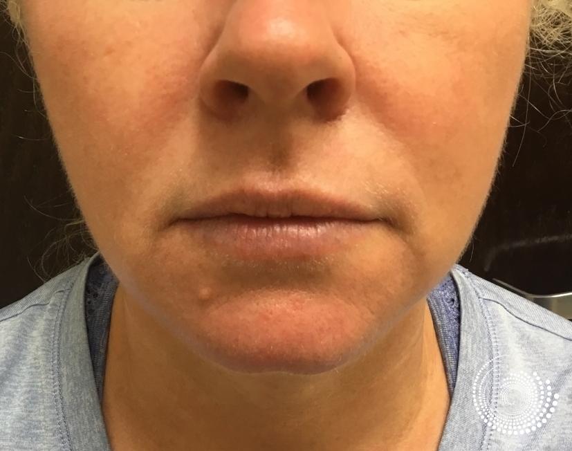 Filler - Lips: Patient 3 - Before 