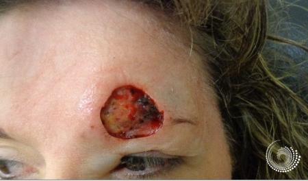 Basal Cell skin cancer, forehead near eyebrow - Mohs surgery -  After 2