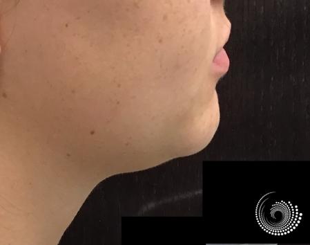 Kybella: Patient 1 - After 2