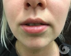 Filler - Lips: Patient 5 - Before 