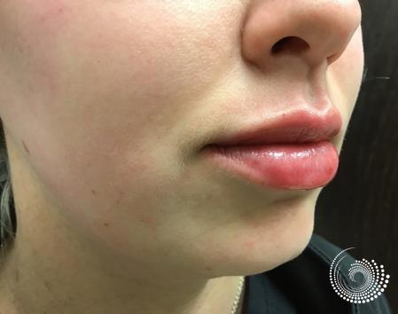 Filler - Lips: Patient 5 - After 2