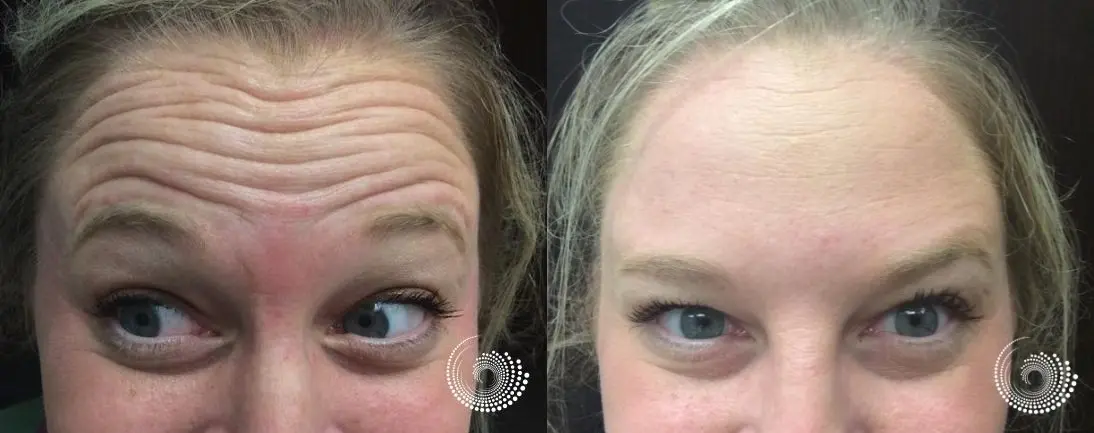 Botox injections smooth forehead and frown lines - Before and After