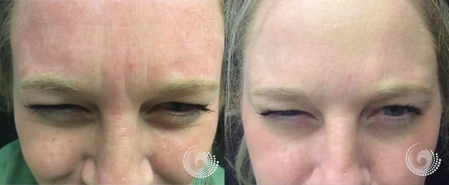 Botox injections smooth forehead and frown lines - Before and After 2