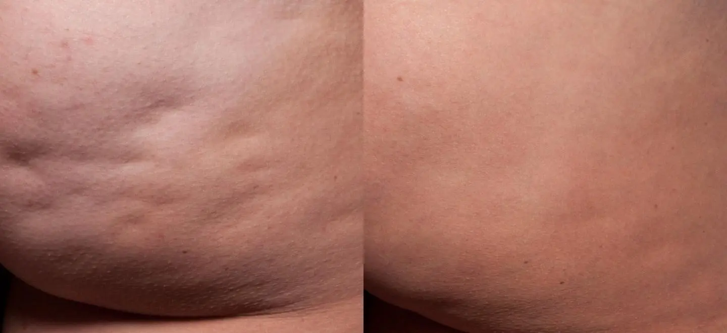 Cellfina to treat cellulite on buttocks - Before and After