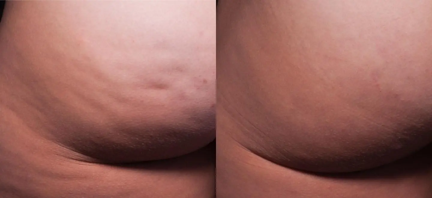Cellfina eliminates cellulite on buttocks - Before and After