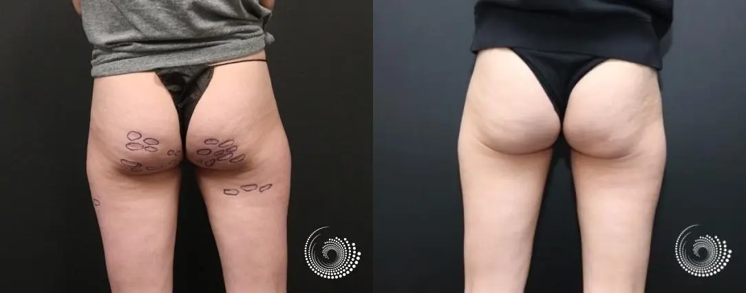 Cellfina eliminates cellulite at the root cause. - Before and After 2