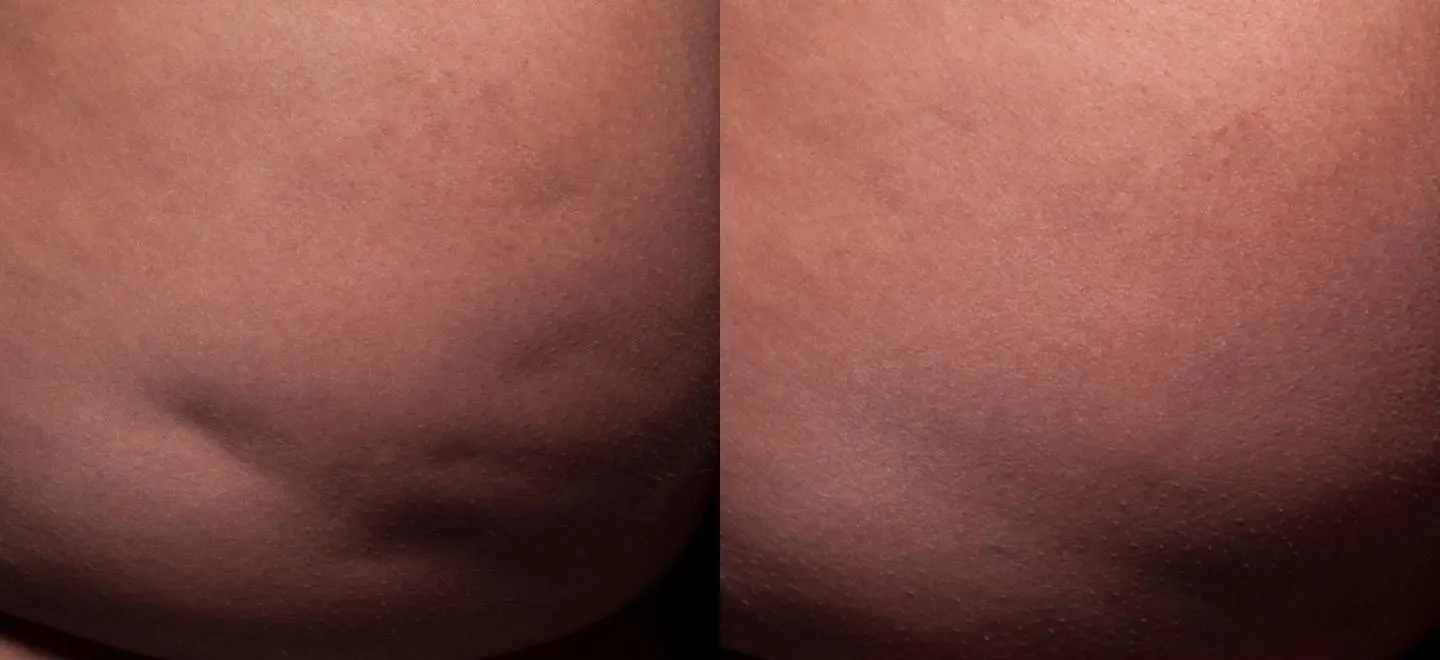 Cellfina to treat cellulite - Before and After