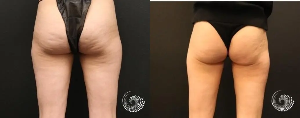 Cellfina eliminates cellulite at the root cause. - Before and After