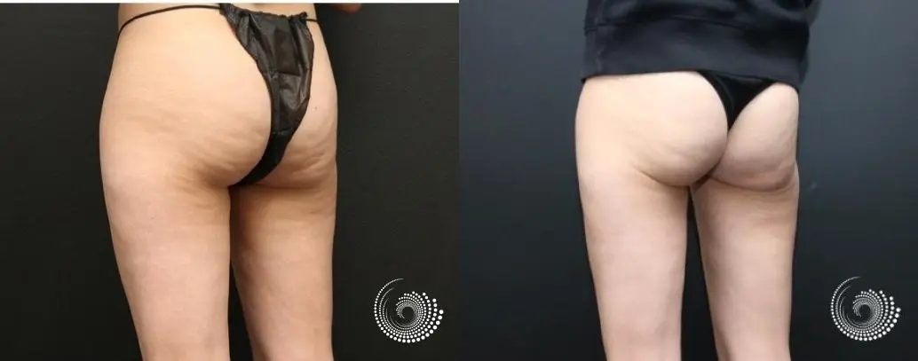 Cellfina eliminates cellulite at the root cause. - Before and After 3