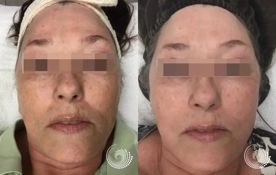 Melanage Peel series of  two to even skin tone - Before and After 1