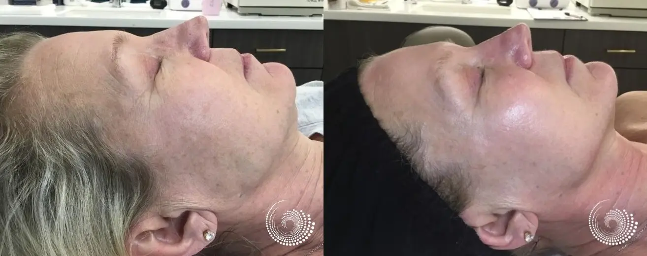 Melanage Mini Peel to even skin tone - Before and After 3