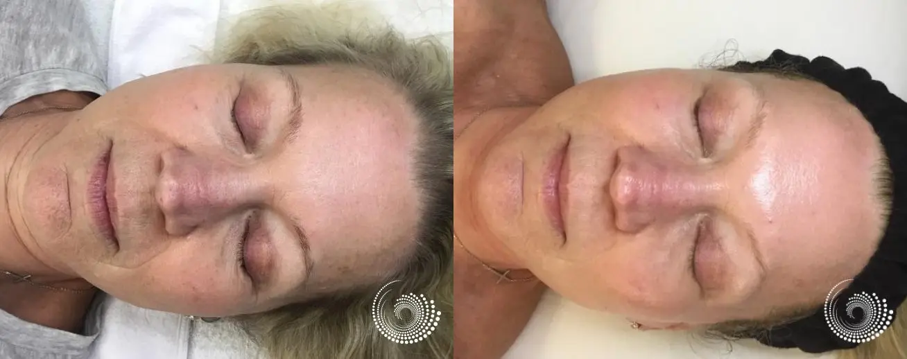 Melanage Mini Peel to even skin tone - Before and After
