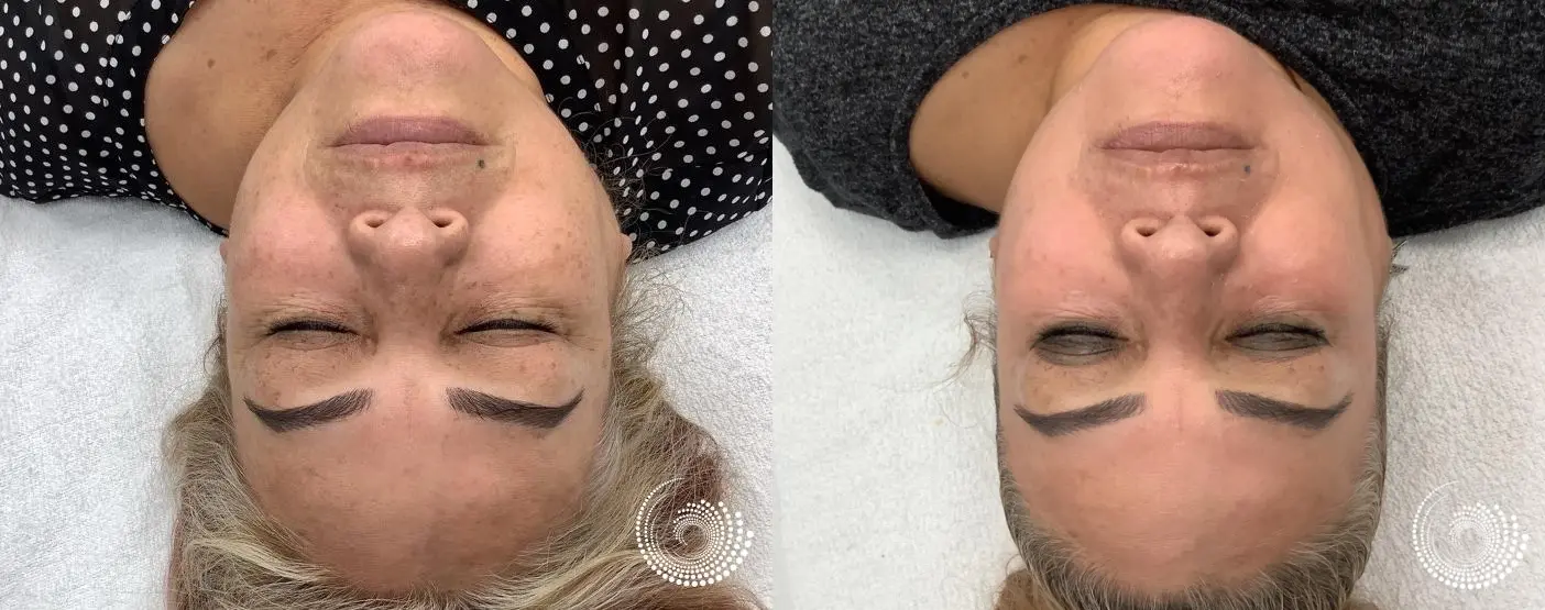 Melanage Mini Peel for dark sun damage - Before and After 2