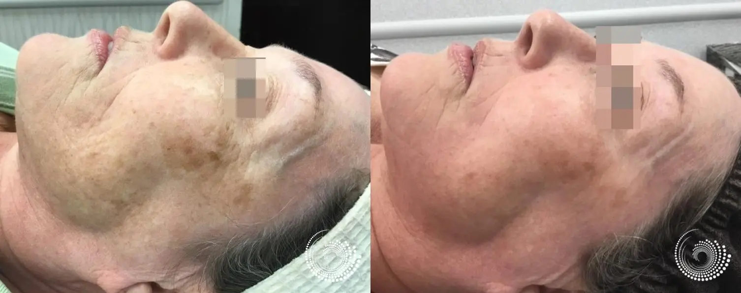 Melanage Peel series of  two to even skin tome - Before and After 2