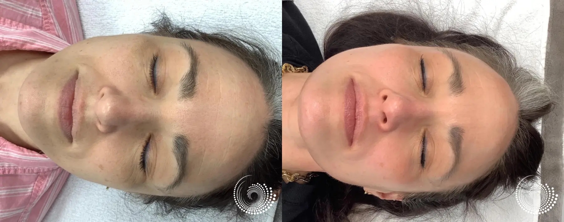 Melanage Mini Peel for dark spots - Before and After