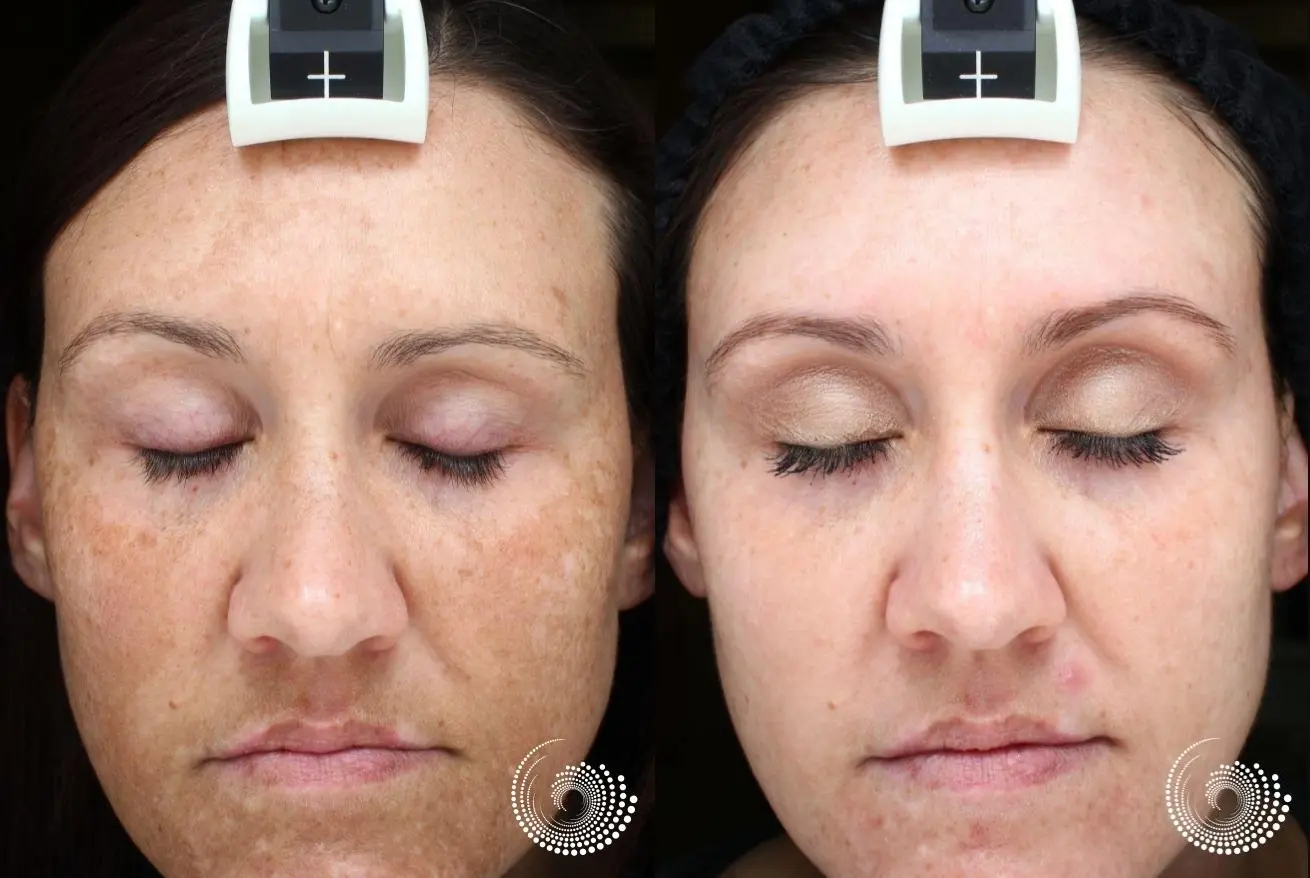 Melanage peel – significant reduction in brown spots - Before and After 1